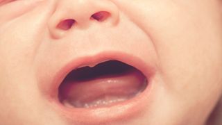Tongue tie in babies