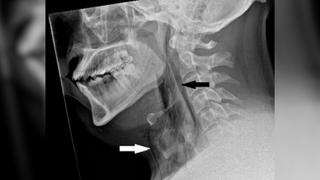 X-ray image of the man's neck and skull with a white and a black arrow pointing to areas of trapped air underneath the skin of his neck