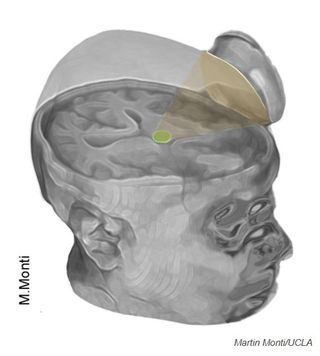 The researchers used a saucer-like device to aim ultrasonic pulses at the brain's thalamus.