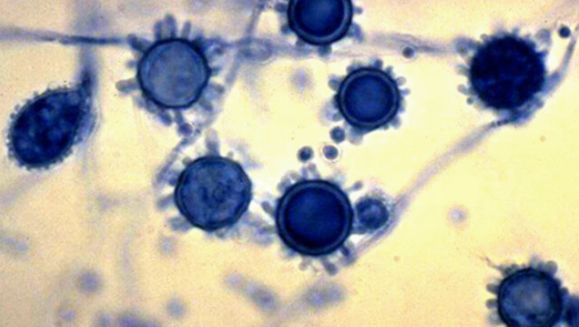 lung disease, histoplasma