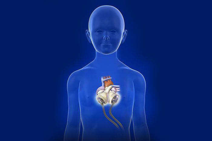 SynCardia Artificial heart graphic