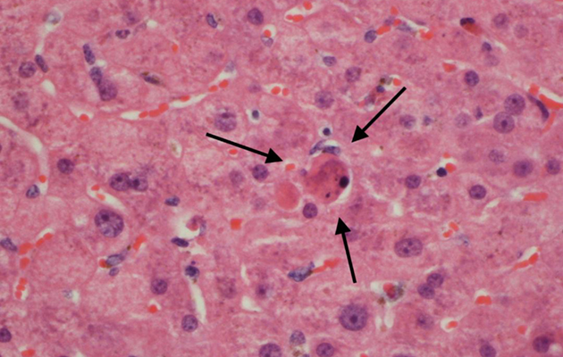 Liver disease slide