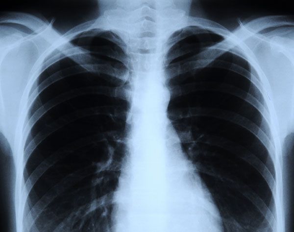 chest x-ray lung cancer deaths