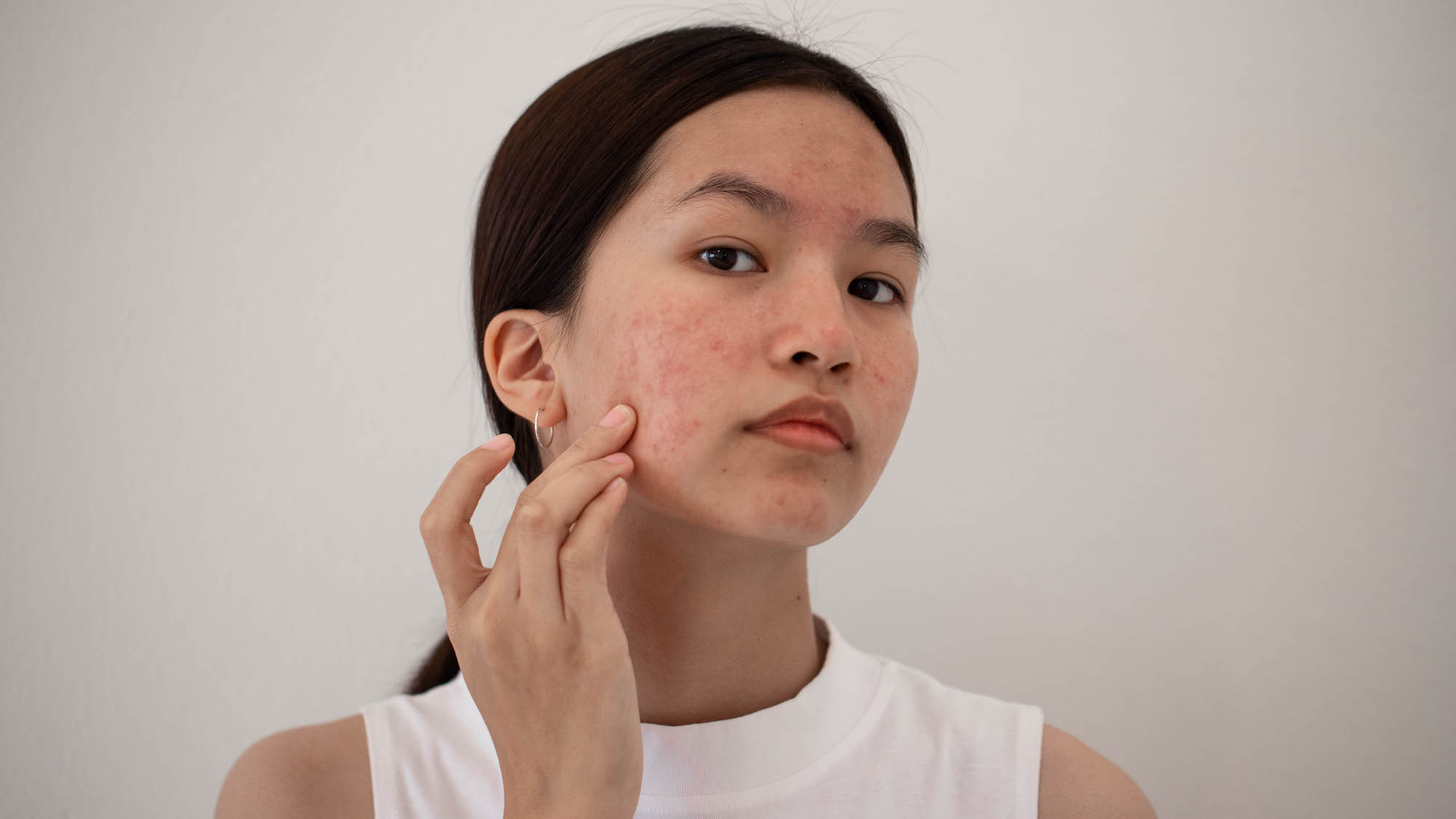 Woman with bare skin touching acne prone skin