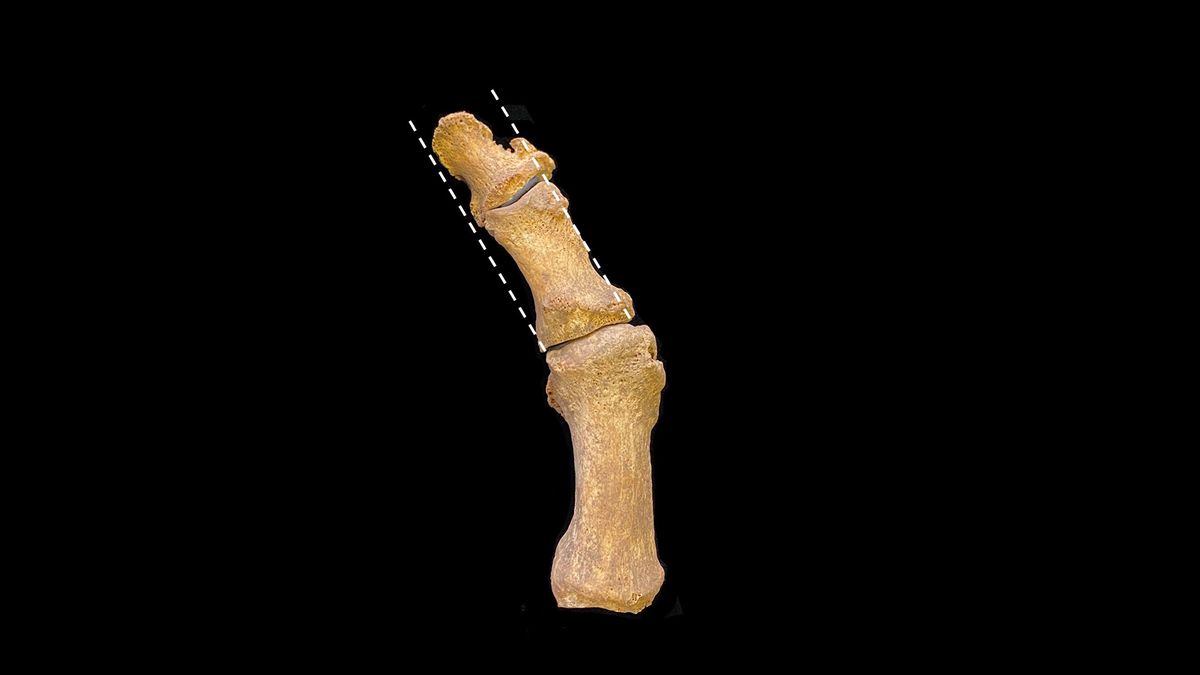 Excavated medieval foot bones showing the foot deformity known as hallux valgus, with lateral deviation of the big toe.