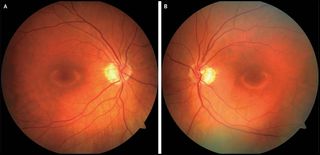 A woman developed a "bull's-eye" pattern inside both of her eyes, a sign of damage caused by a prescription drug she was taking. Above, images showing the woman's retinas (the light-sensitive cells at the back of the eye) in both the right and left eye. A