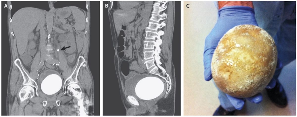 bladder stone, nejm