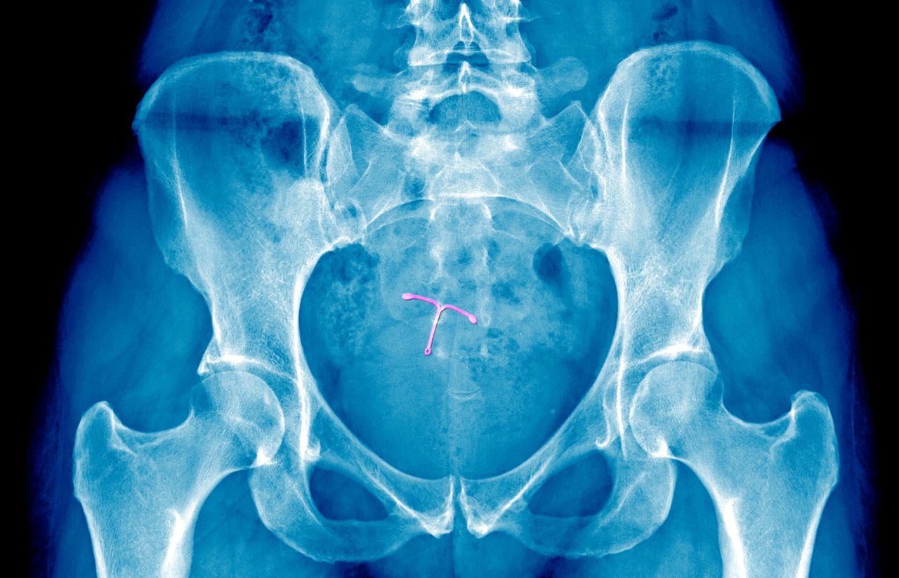 An X-ray of an IUD.