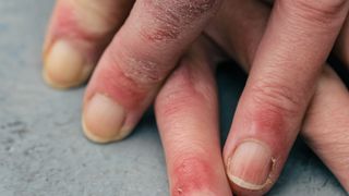 fingers with chilblains