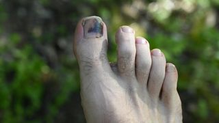 A hiker's foot in the foliage with a bruised toenail