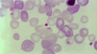 A microscope image of blood cells being infected with parasites. The cells are various shades of purple against a yellowy-white background.