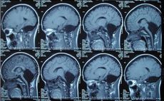 MRI scans of the patient's brain show a large hole where the cerebellum should be.