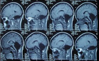 MRI scans of the patient's brain show a large hole where the cerebellum should be.