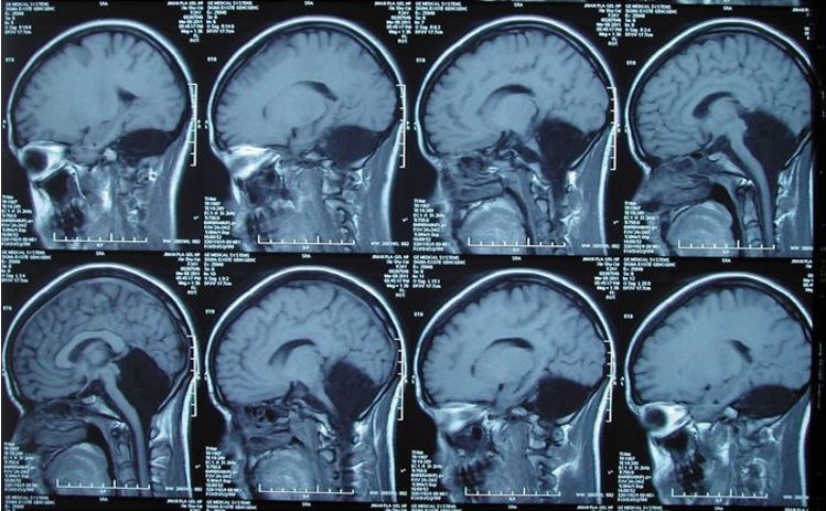 MRI scans of the patient&#039;s brain show a large hole where the cerebellum should be.