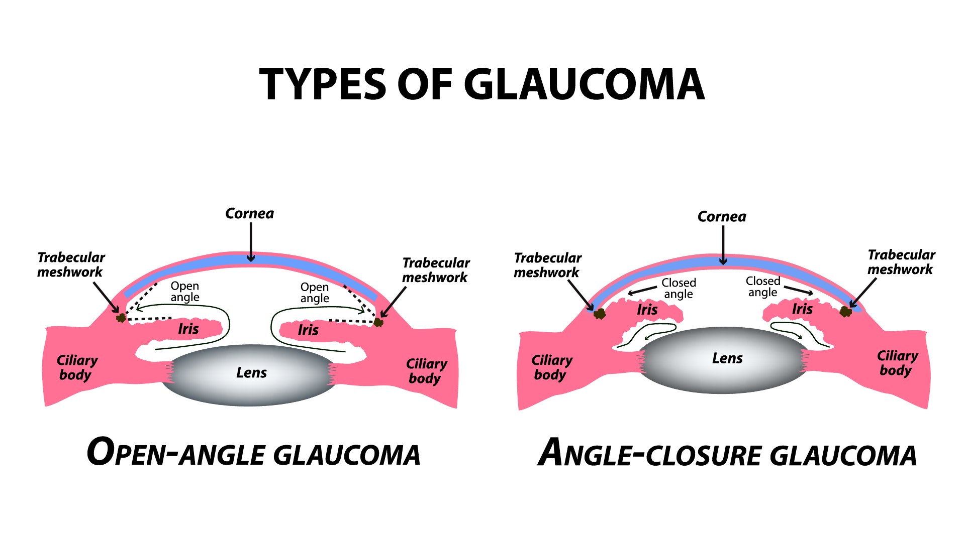 Infographic of the two main types of glaucoma - Open-angle and angle-closure glaucoma. Timonina via Shutterstock