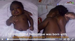 A photo of Dominique before her surgery.