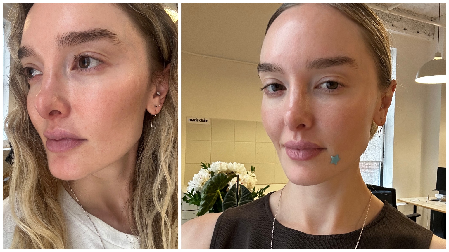 Hannah Baxter acne routine
