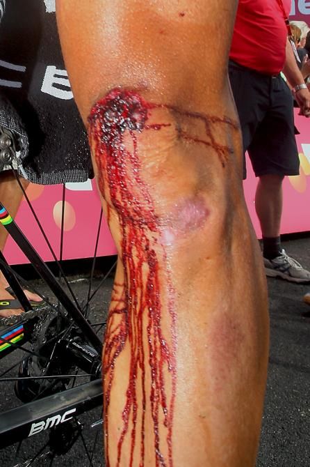 Philippe Gilbert's knee injury required stitches