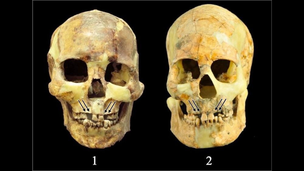 Two side-by-side skulls with missing teeth.