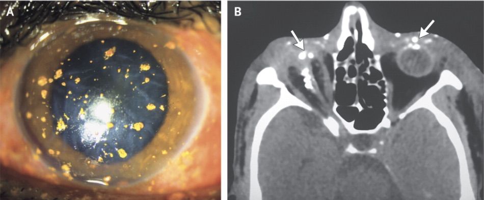 nejm, eye, firecracker, eye injury