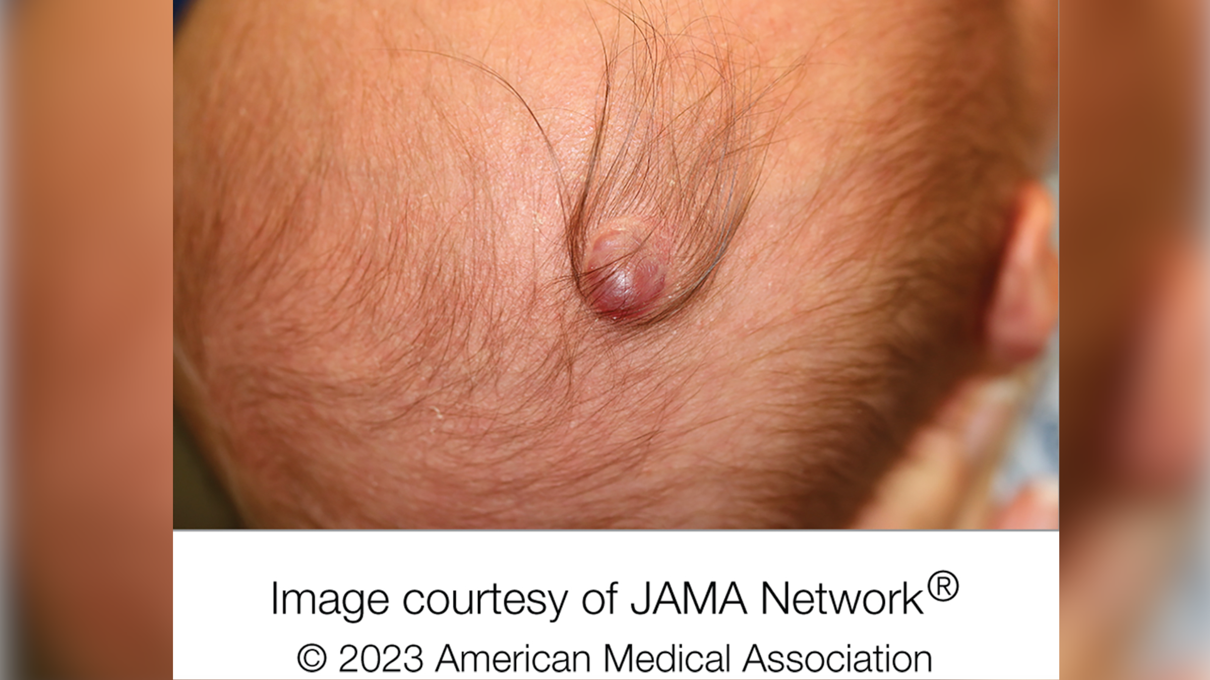 Strange Purple Lump On Infant S Head Is Rare Case Of Protruding Brain Tissue Case Report Says