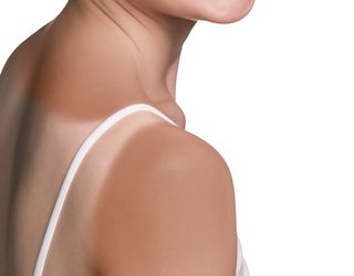 A woman's shoulder shows an uneven suntan.