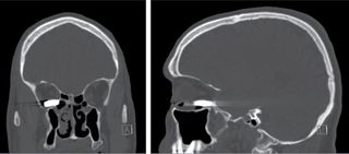 This CT scan shows a bullet that came to rest in a man&#039;s eye socket.