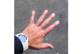Fehntrich's hand several weeks after the injury.
