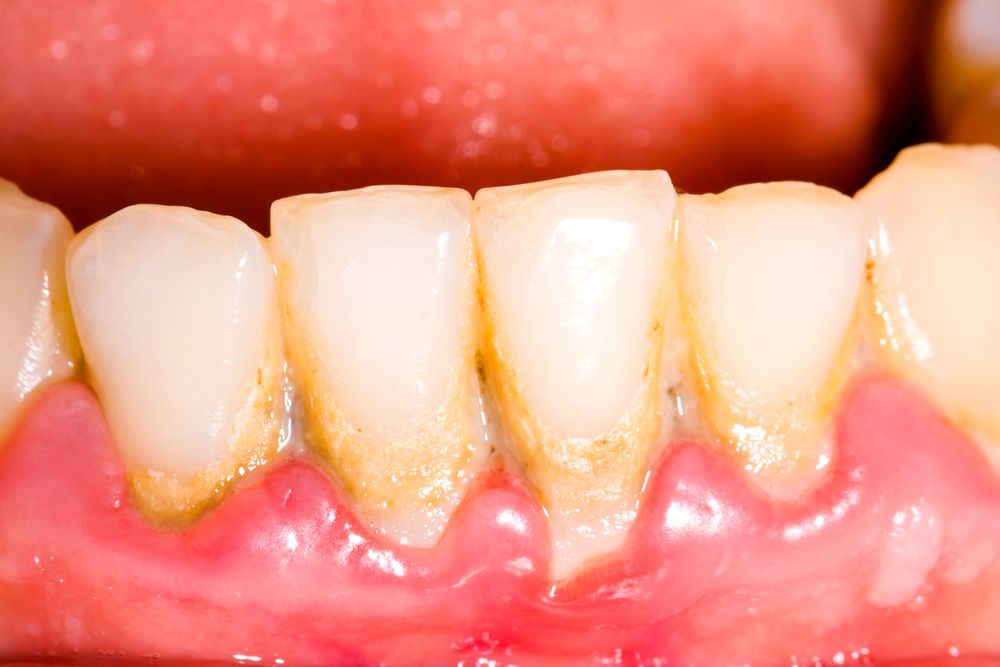 Gingivitis Periodontitis Symptoms Treatment Of Gum Disease