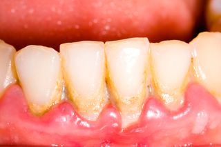 white gum infection