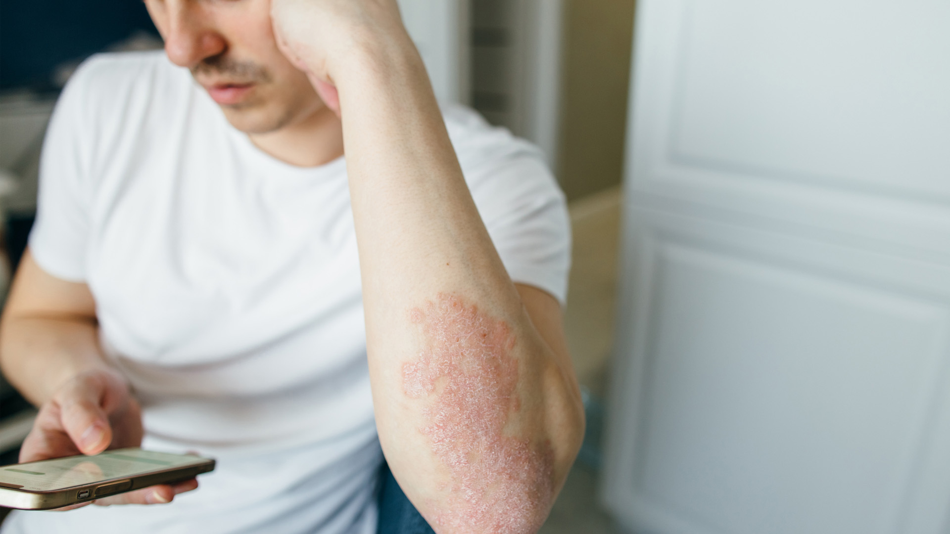 man with psoriasis on his elbow