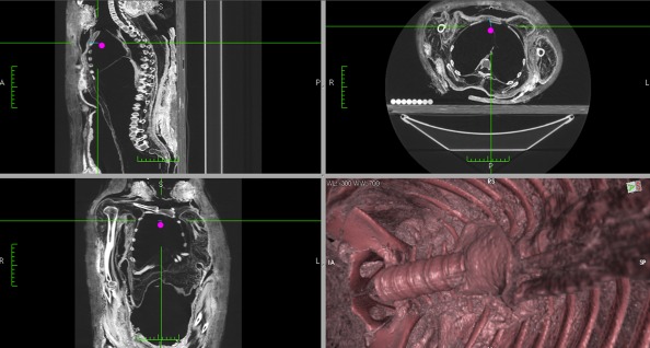 A mummy gets its empty chest cavity reconstructed via CT scan