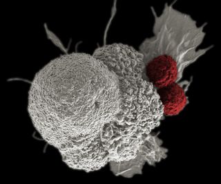 This colored scanning electron micrograph of an oral squamous cancer cell (white) being attacked by two cytotoxic T cells (red), part of a natural immune response. 