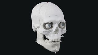Because the man was missing his jaw, Nilsson made one for him based on measurements from the skull.