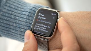 Apple Watch ECG - sinus rhythm
