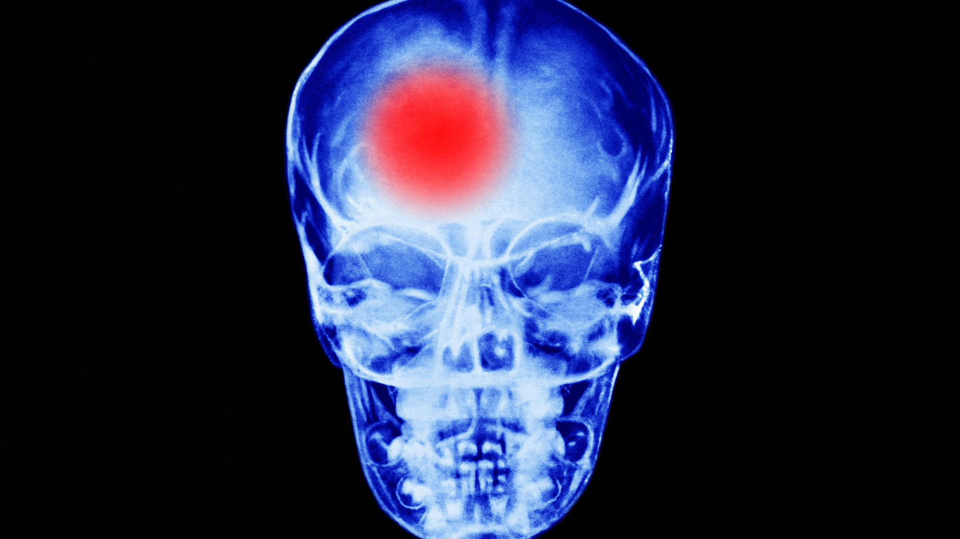 An x-ray scan of a person's skull, facing the camera. A bright red dot glows in the top left section of their brain.