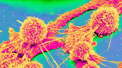 Multi-colored fluorescent image showing three colon cancer cells in high-resolution under the microscope. The cells are pink blobs covered in yellow string-like structures. The cells are surrounded by patches of green against a blue background.
