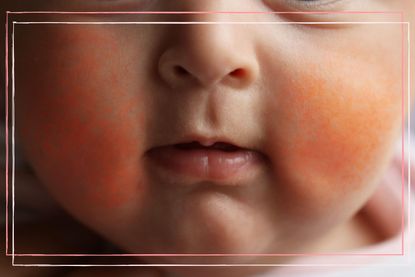 A close up of a child with slapped cheek syndrome showing two red cheeks, which is a symptom of slapped cheek.