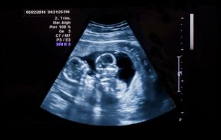 Twin ultrasound