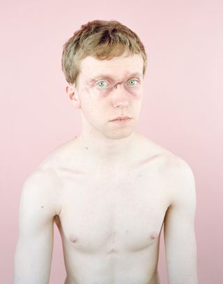 Young man with no shirt on with bruised face.