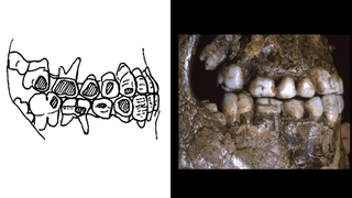 Drawing of teeth with wear next to a photograph of a jaw with worn teeth