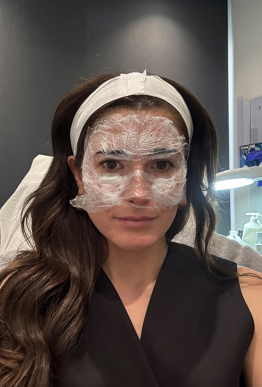 Eleanor usando crema anestésica antes de su tratamiento Sofwave