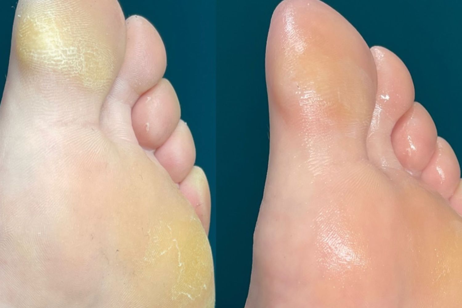a picture of dry, flaky feet before and after an elim medi pedicure
