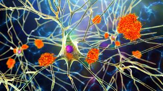 Illustration of amyloid plaques amongst neurons and neurofibrillary tangles inside neurons.