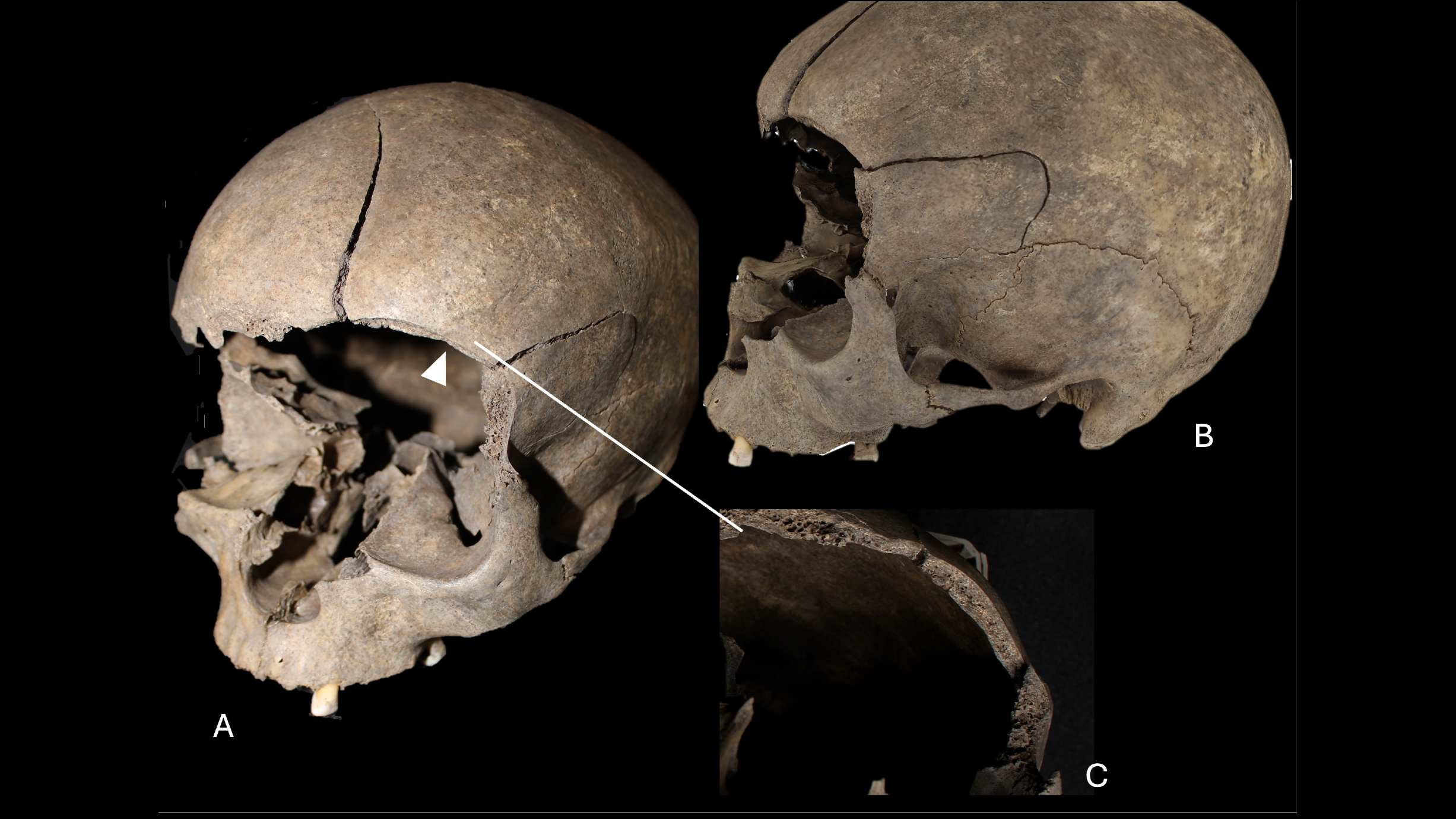 three views of a human skull revealing head trauma