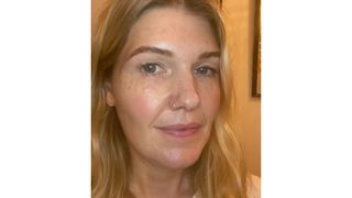 Beauty editor Fiona McKim pictured after the polynucleotide treatment with bumps under her eyes