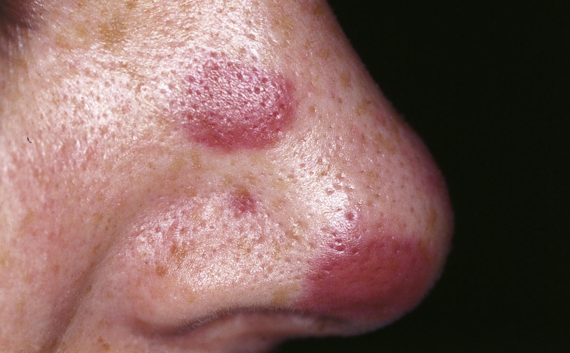 A close-up of a woman's nose, showing big purplish blotches on it