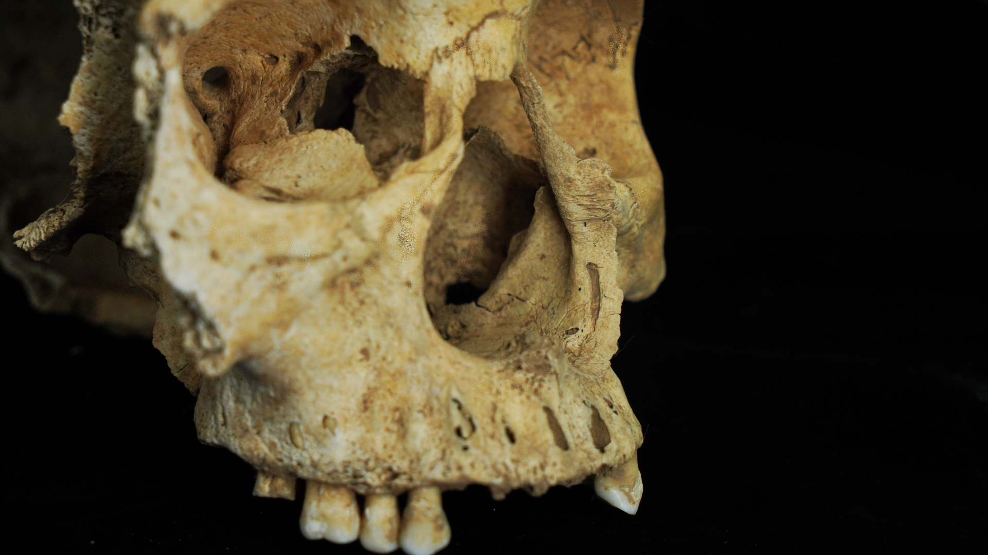 a three-quarter view of a human skull showing in greater detail a damaged nasal opening