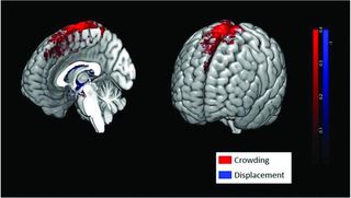 Spaceflight causes crowding and displacement of brain tissue. Crowding is seen at the vertex and occurs when the brain shifted upward, while displacement is seen along the margins of the lateral and third ventricles due to enlargement of the ventricles post-spaceflight.