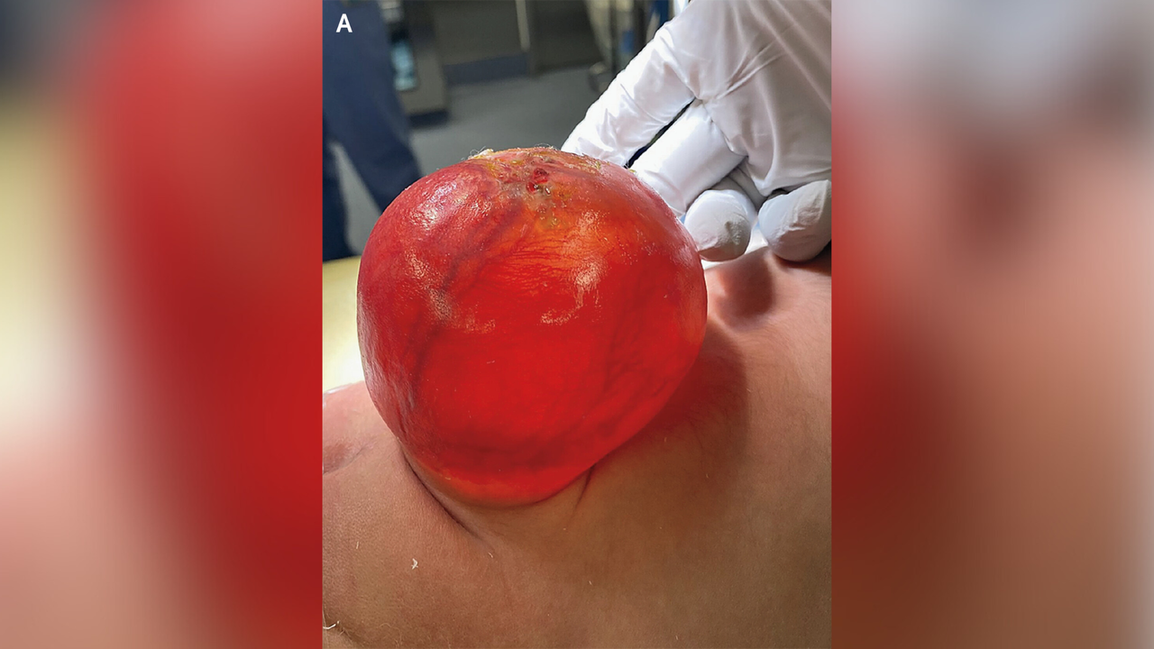 A close-up picture of the "red balloon"-like sac structure that was protruding from the newborn's spine.